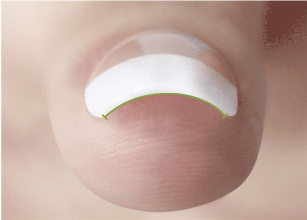 Príklad správne vymodelovaného C oblúka na nechte