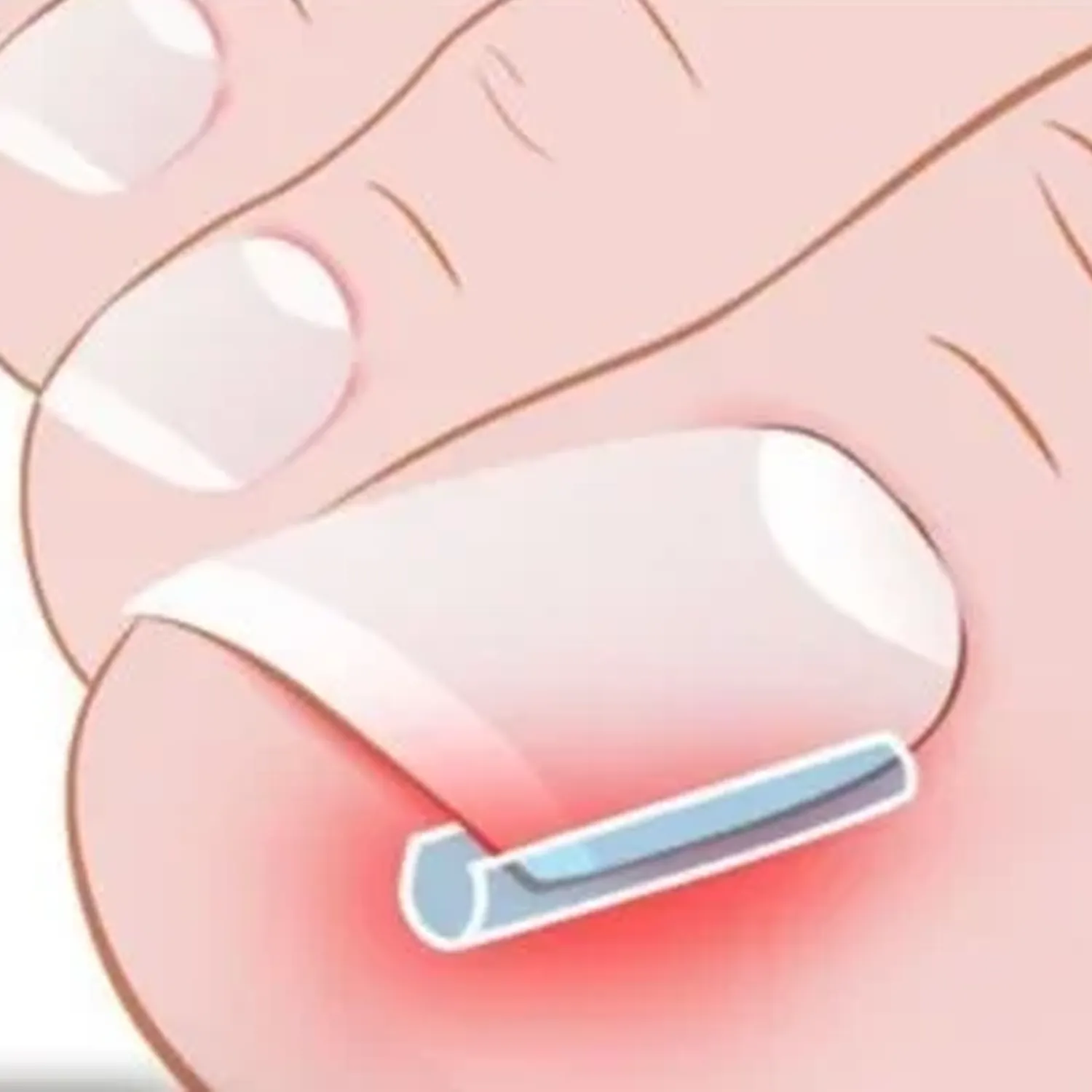 Elastick&eacute; ochrann&eacute; p&aacute;sky na zarasten&eacute; nechty &ndash; obsah balenia